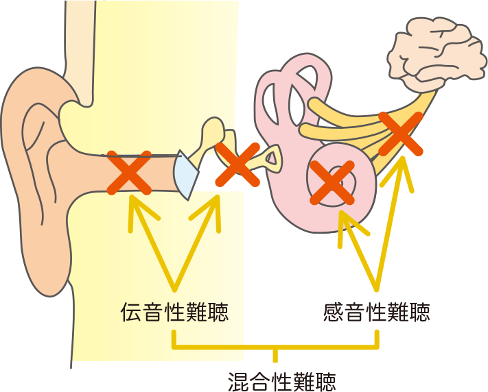 伝音性難聴、感音性難聴、混合性難聴の図解