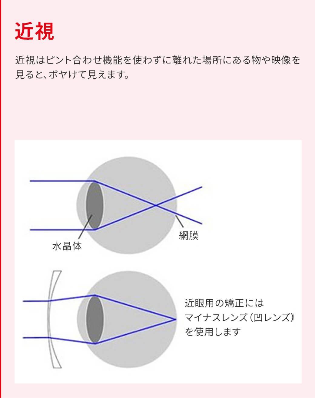 近視 近視はピント合わせ機能を使わずに離れた場所にある物や映像を見ると、ボヤけて見えます。