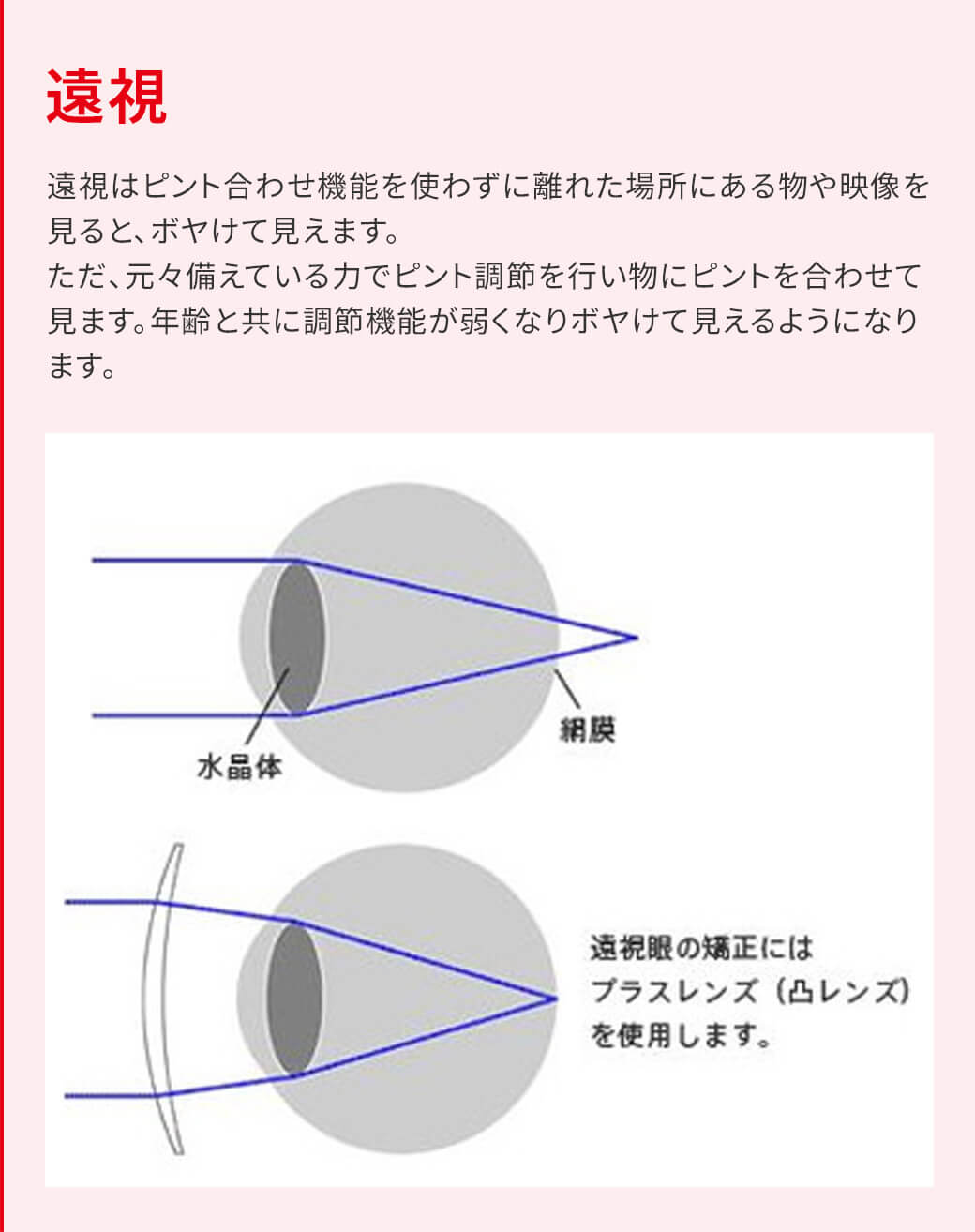 遠視 遠視はピント合わせ機能を使わずに離れた場所にある物や映像を見ると、ボヤけて見えます。ただ、元々備えている力でピント調節を行い物にピントを合わせて見ます。年齢と共に調節機能が弱くなりボヤけて見えるようになります。