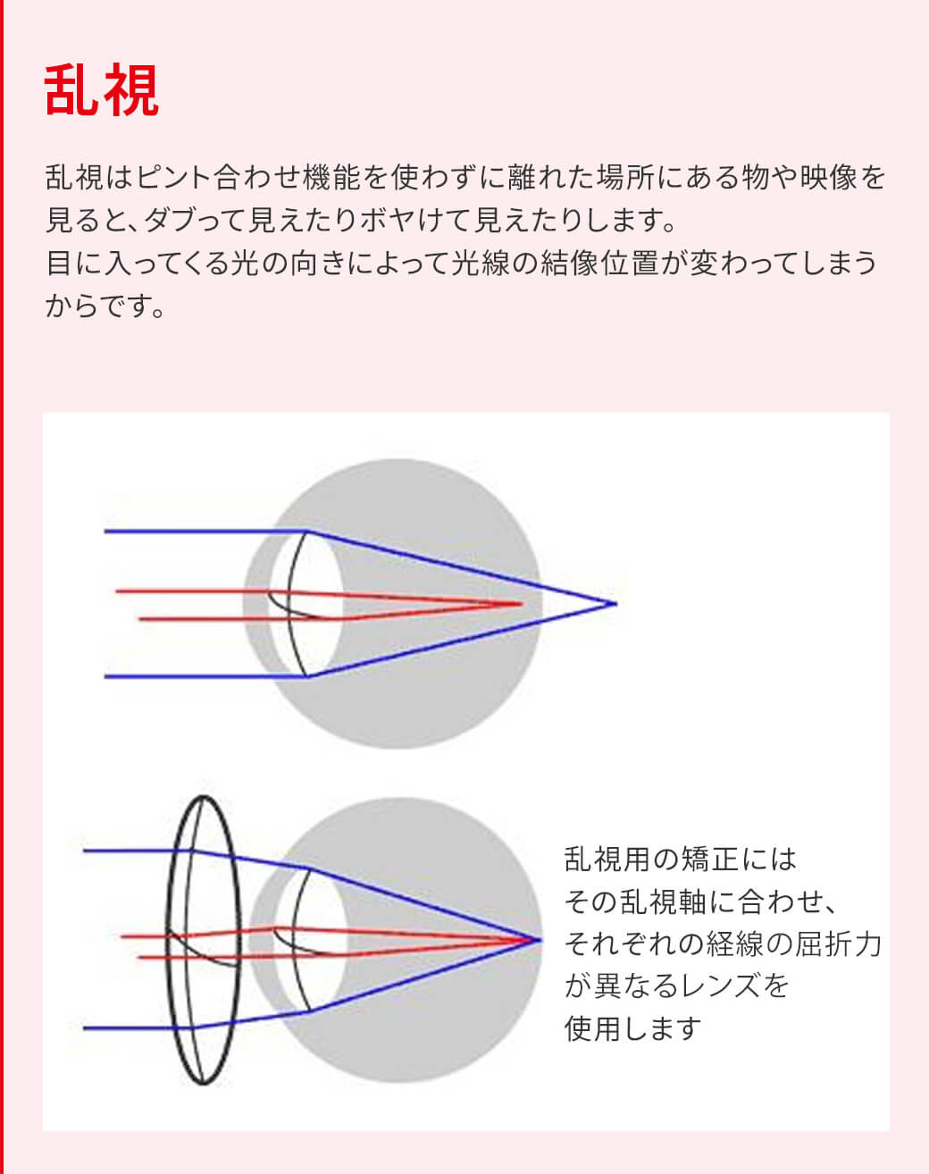 乱視 乱視はピント合わせ機能を使わずに離れた場所にある物や映像を見ると、ダブって見えたりボヤけて見えたりします。目に入ってくる光の向きによって光線の結像位置が変わってしまうからです。